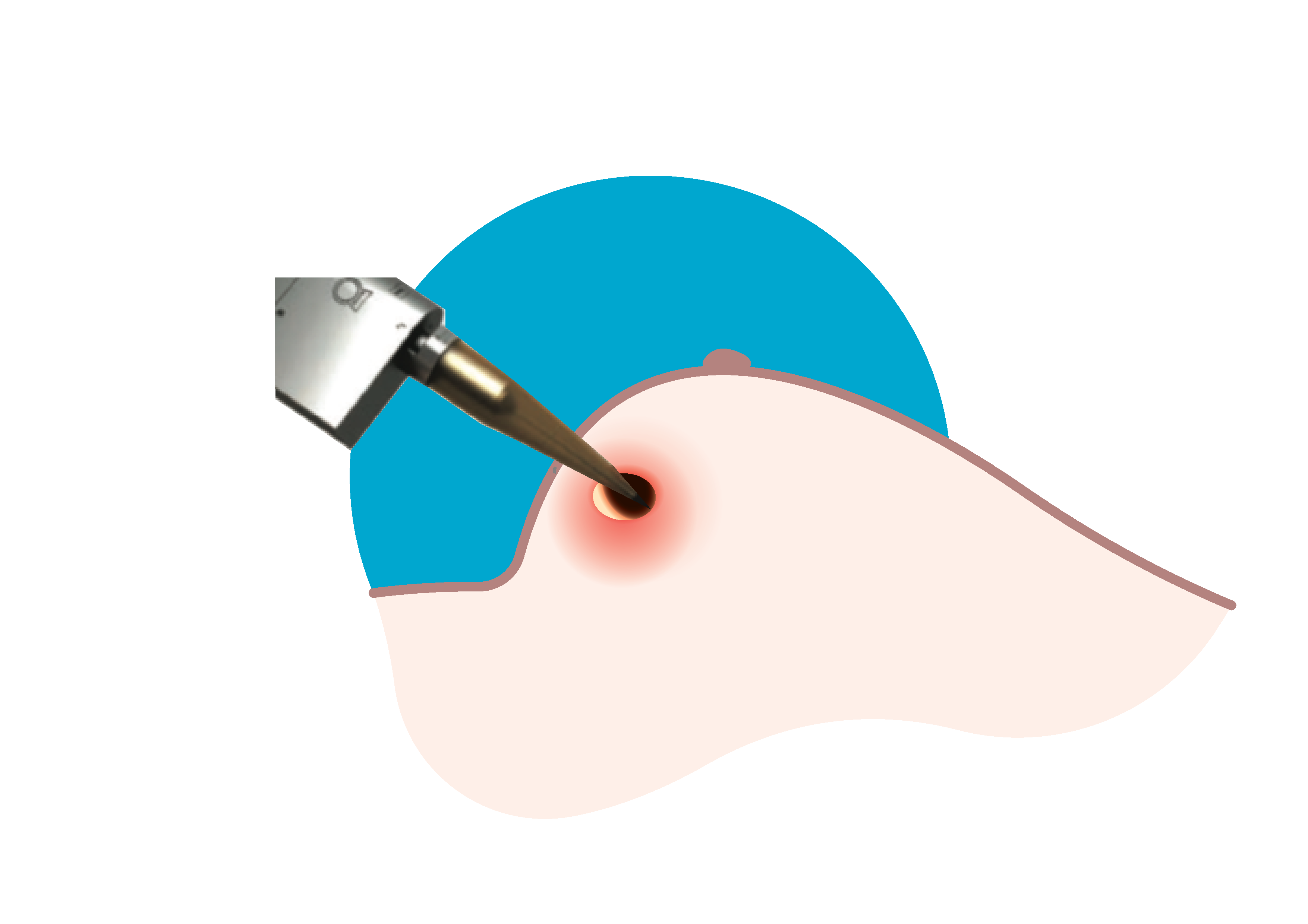 Step 2 The applicator (device that delivers the radiation) is placed exactly at the area where the tumour was removed.