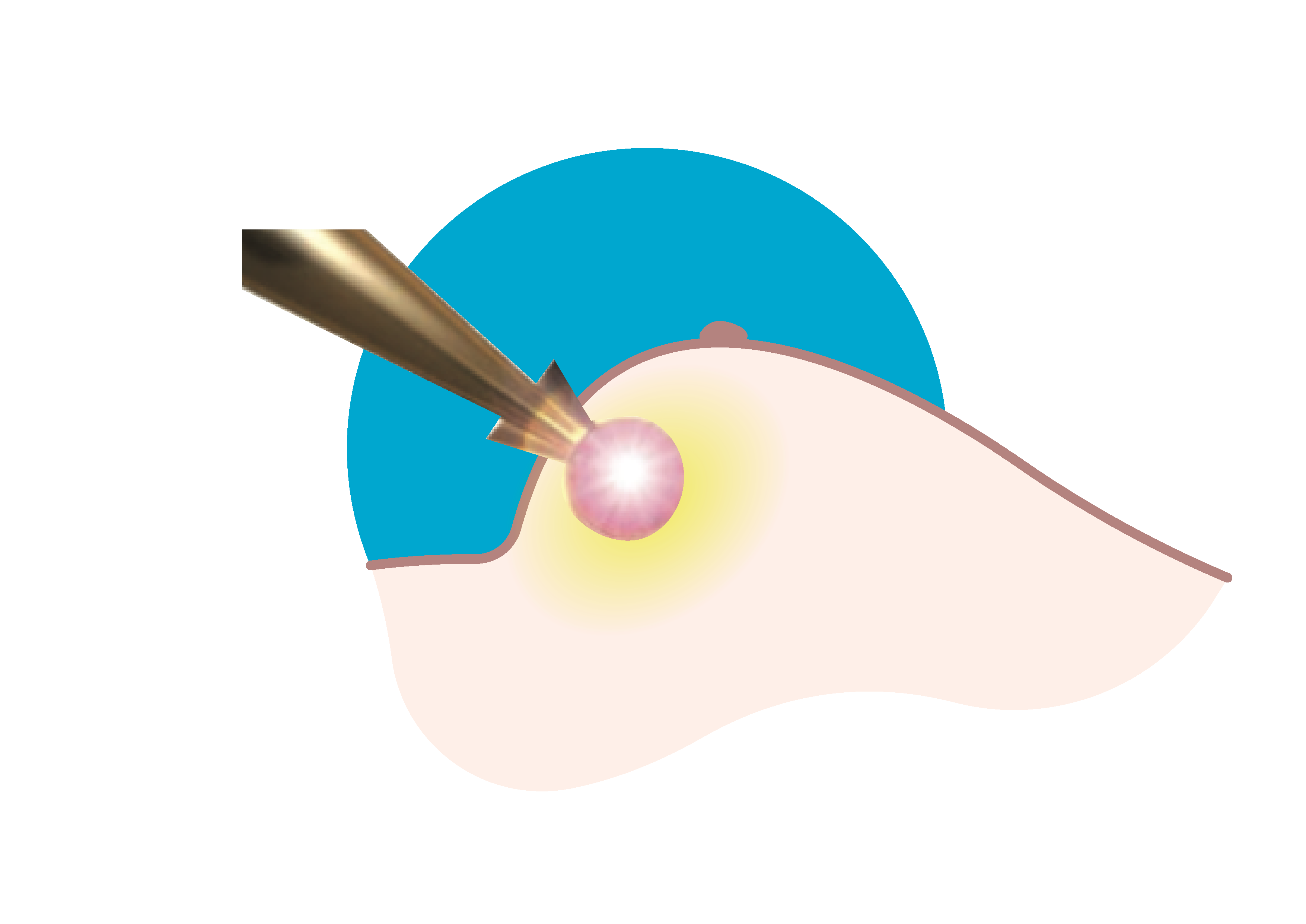 Step 3 Radiation is delivered locally, minimising healthy tissue exposure.